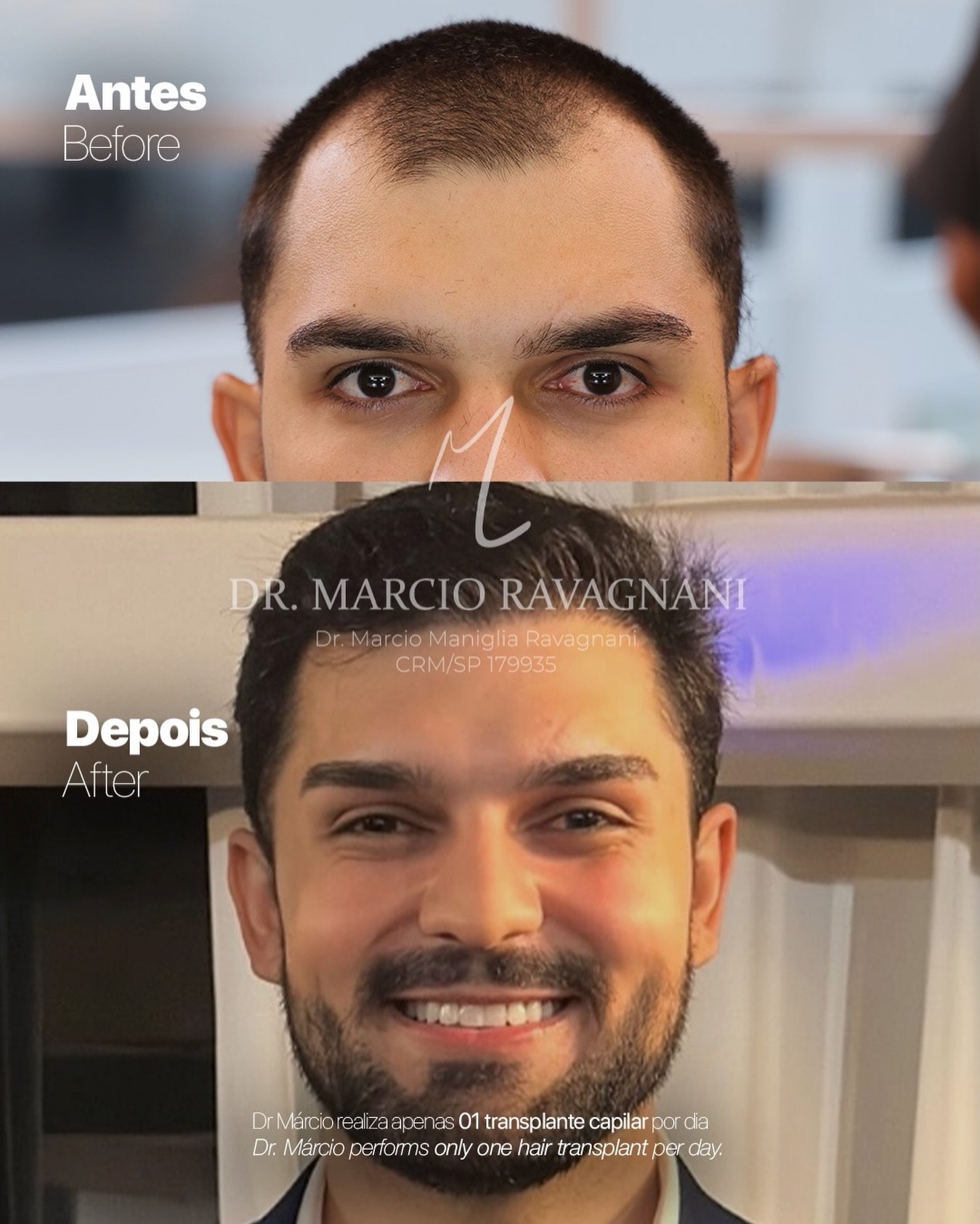 Antes e depois — caso 1 do Dr. Márcio Ravagnani