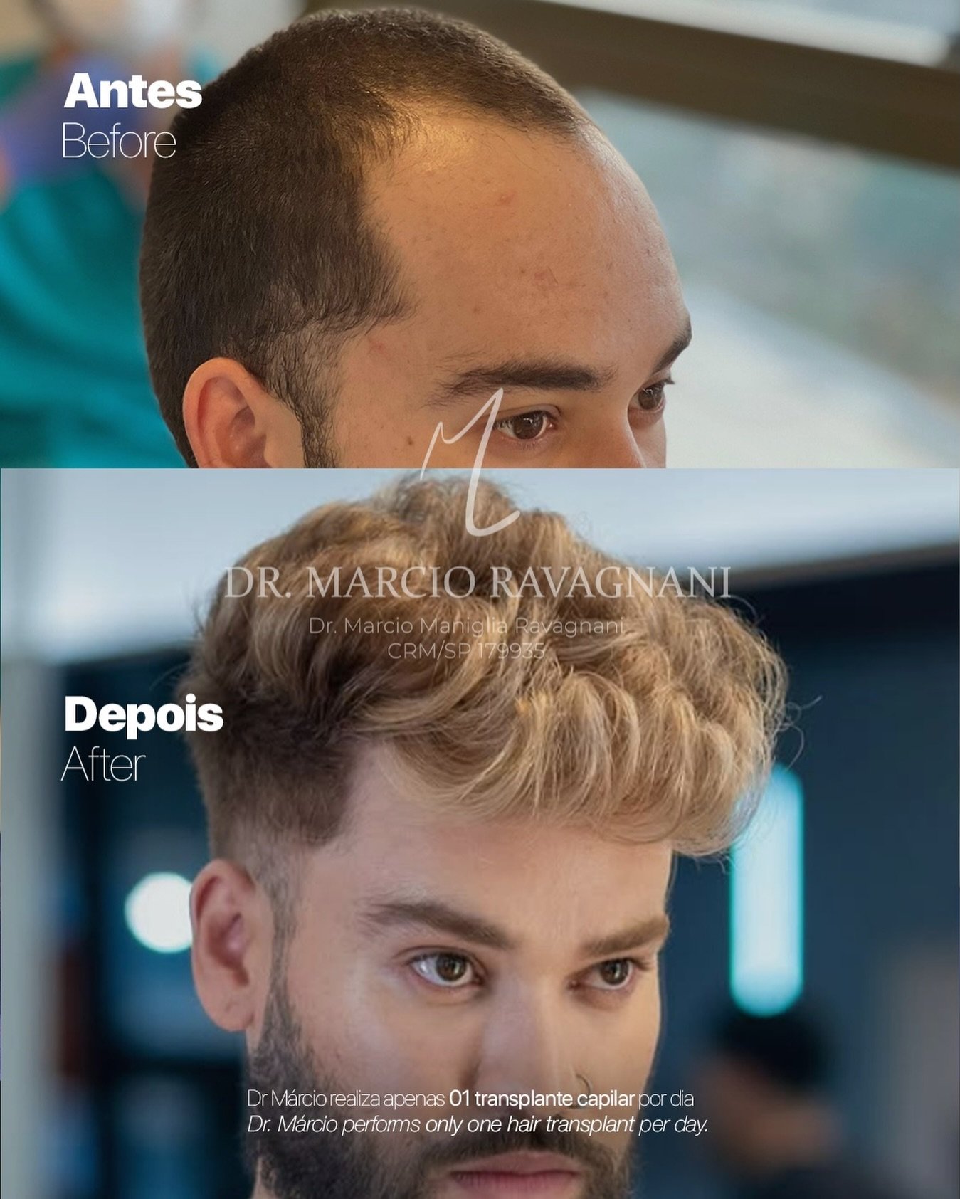 Antes e depois — caso 2 do Dr. Márcio Ravagnani