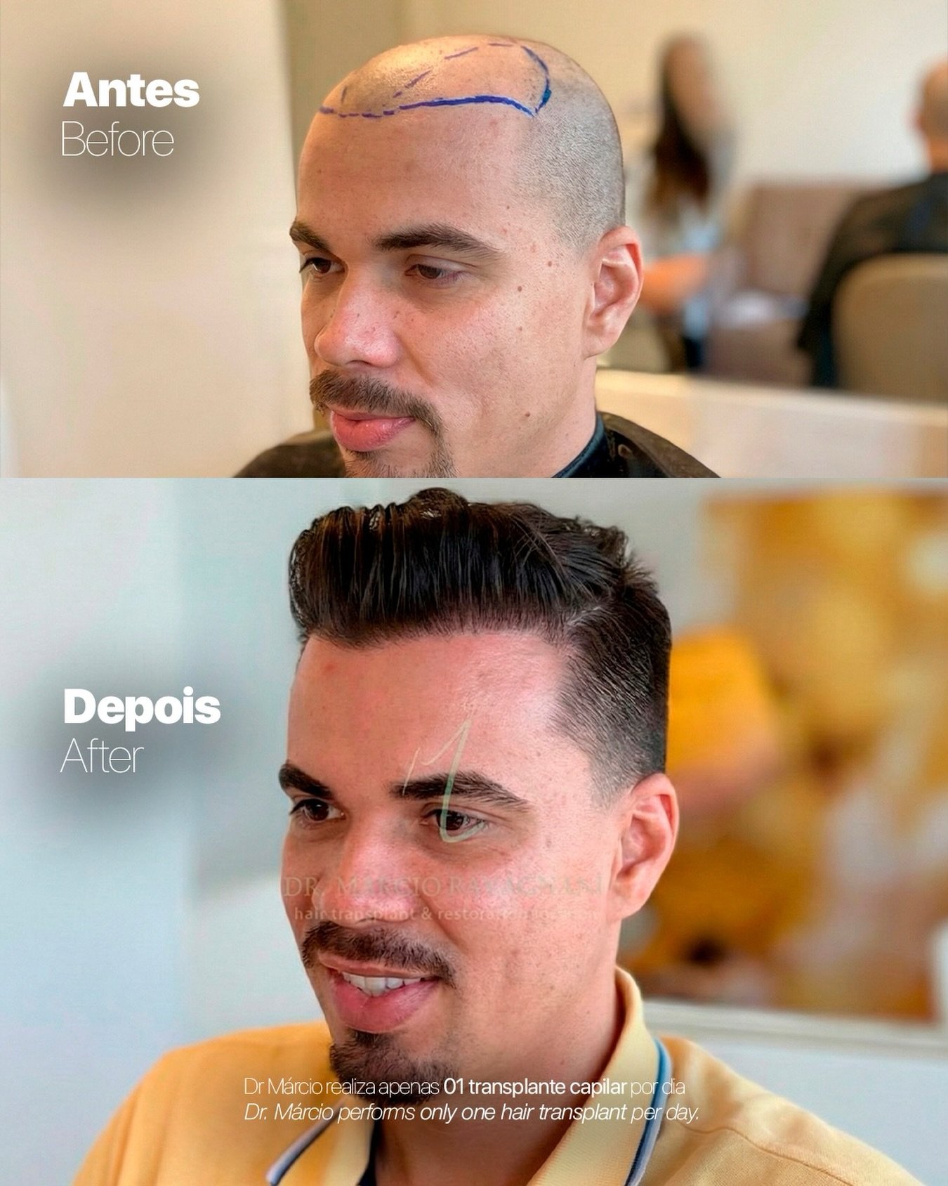 Antes e depois — caso 8 do Dr. Márcio Ravagnani