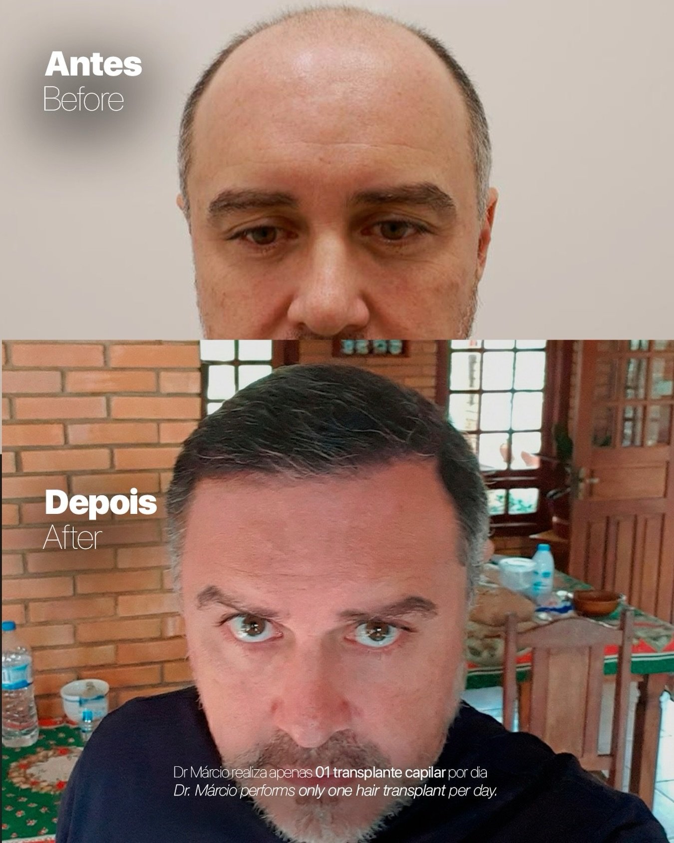 Antes e depois — caso 10 do Dr. Márcio Ravagnani